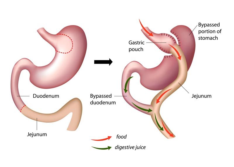 Gastric bypass - Surgery Melbourne