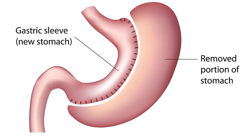 Gastric Sleeve - Surgery Melbourne