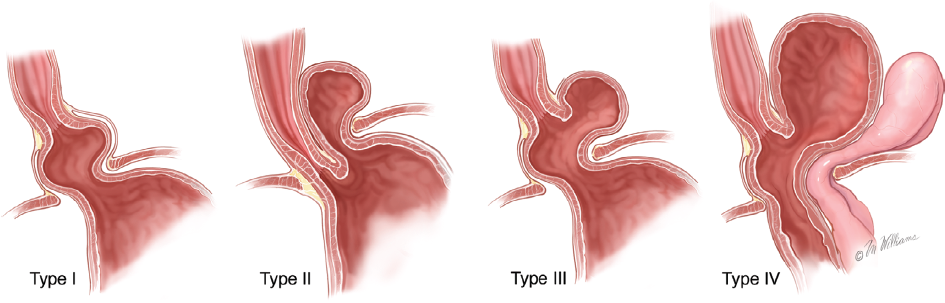 Hiatus Hernia Treatment Dr Ramez Bassari