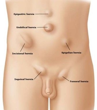 Different types of hernia