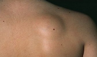 lumps and bumps surgery