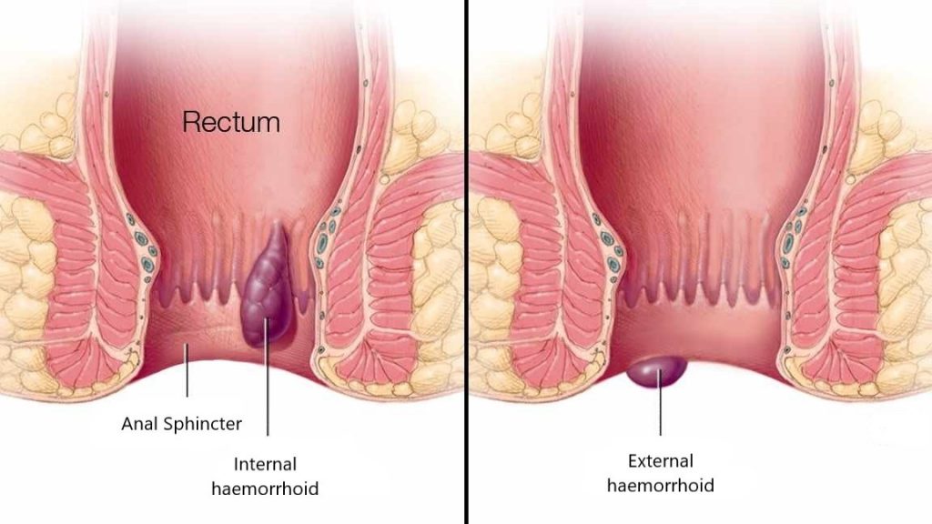 Haemorrhoids