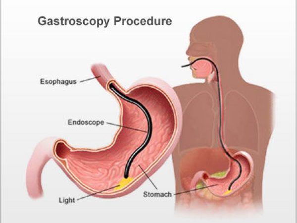 Gastroscopy procedure