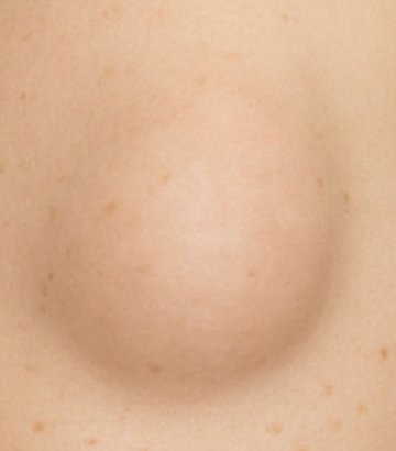 lipoma